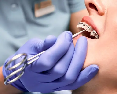 Metal Braces Procedure - Dr. Mariana Orthodontics