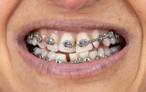 Problems Fixed by Metal Braces - Dr. Mariana Orthodontics